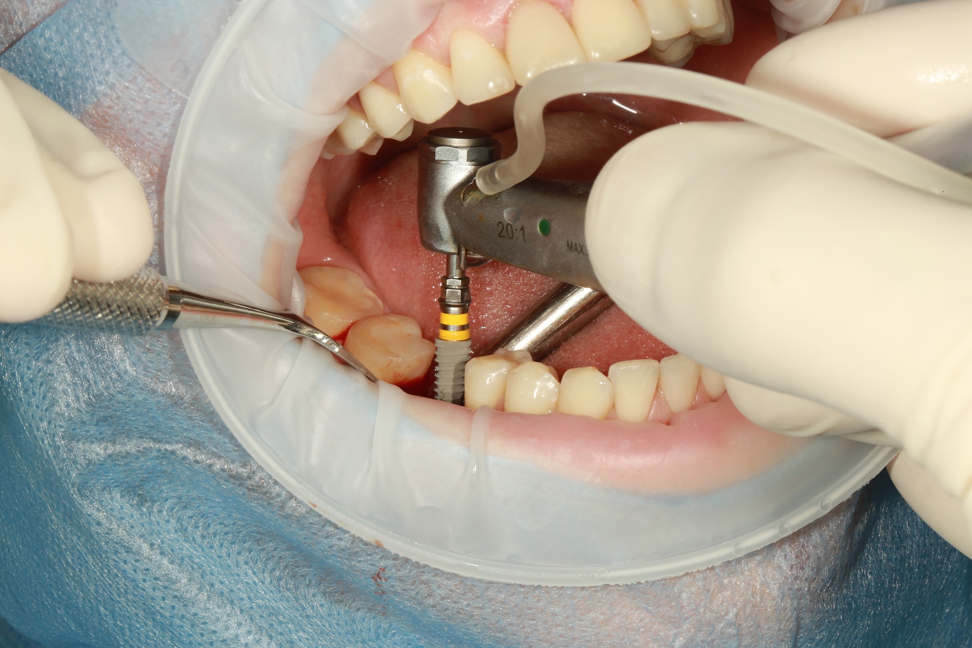 https://dentistspa.us/wp-content/uploads/2023/08/dental-3754769_1920.jpg